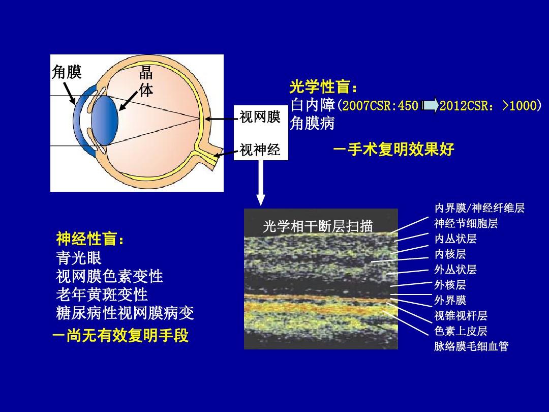 开角型青光眼最新治疗进展概览